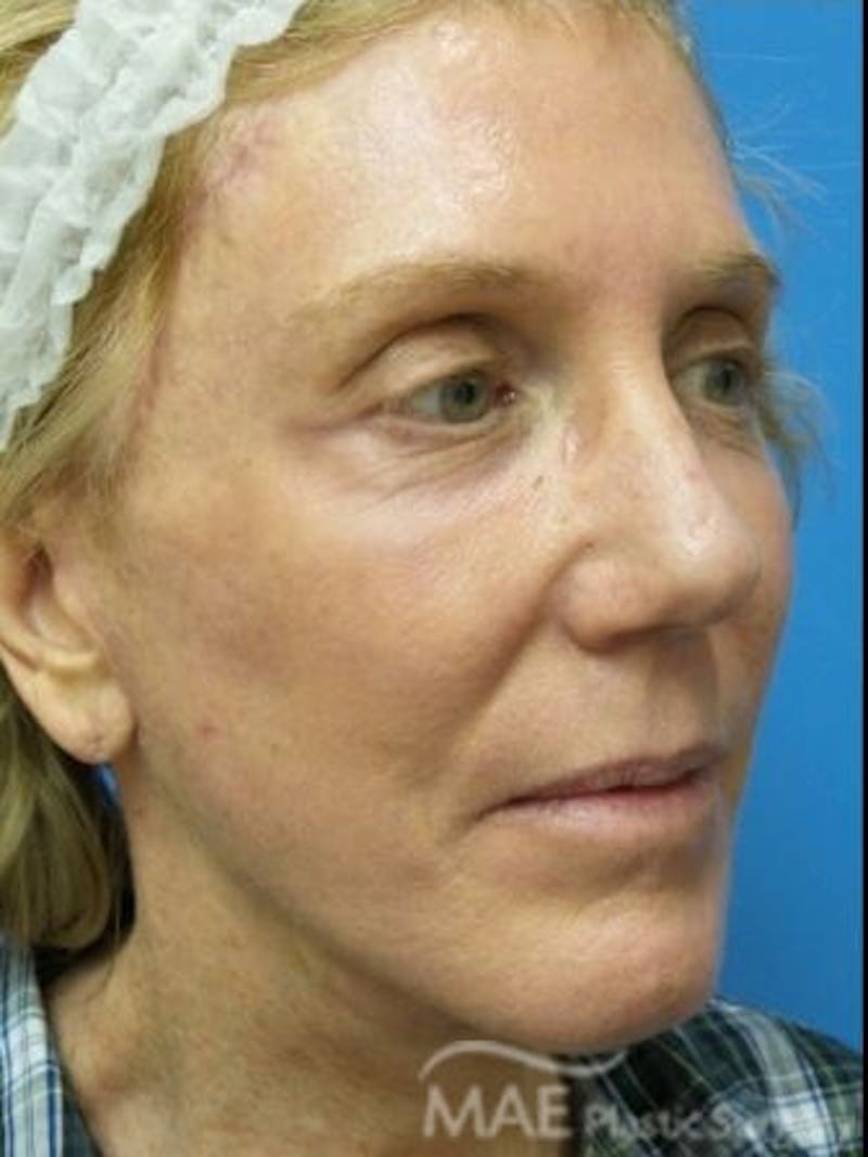 Facelift Before & After Gallery - Patient 353757 - Image 4