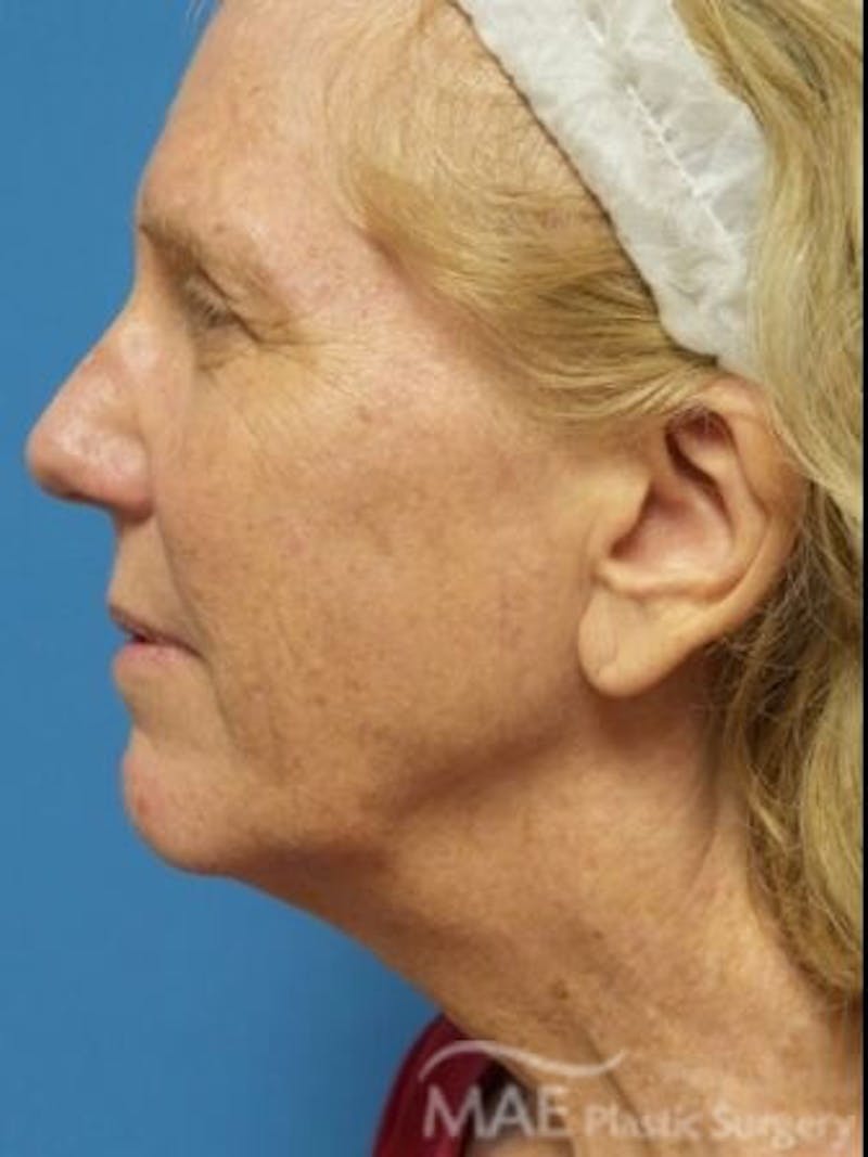 Facelift Before & After Gallery - Patient 353757 - Image 5