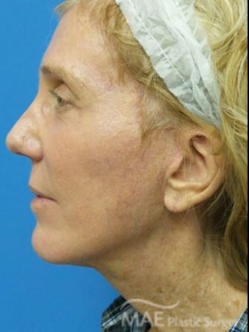 Facelift Before & After Gallery - Patient 353757 - Image 6