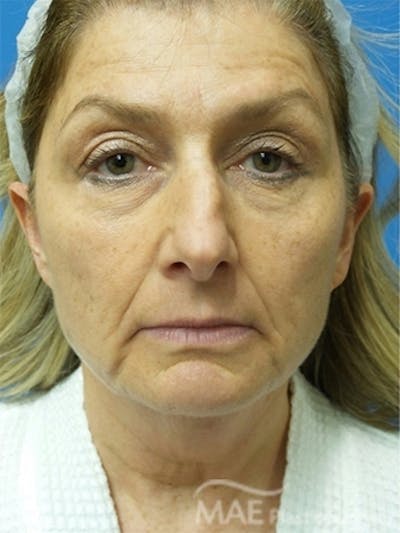 Facelift Before & After Gallery - Patient 313593 - Image 1