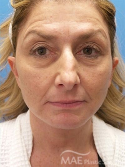 Facelift Before & After Gallery - Patient 313593 - Image 2