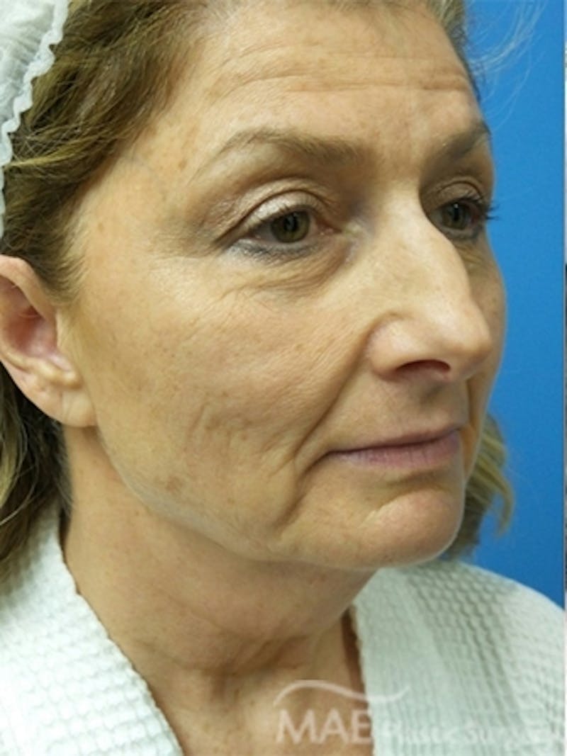 Facelift Before & After Gallery - Patient 313593 - Image 3