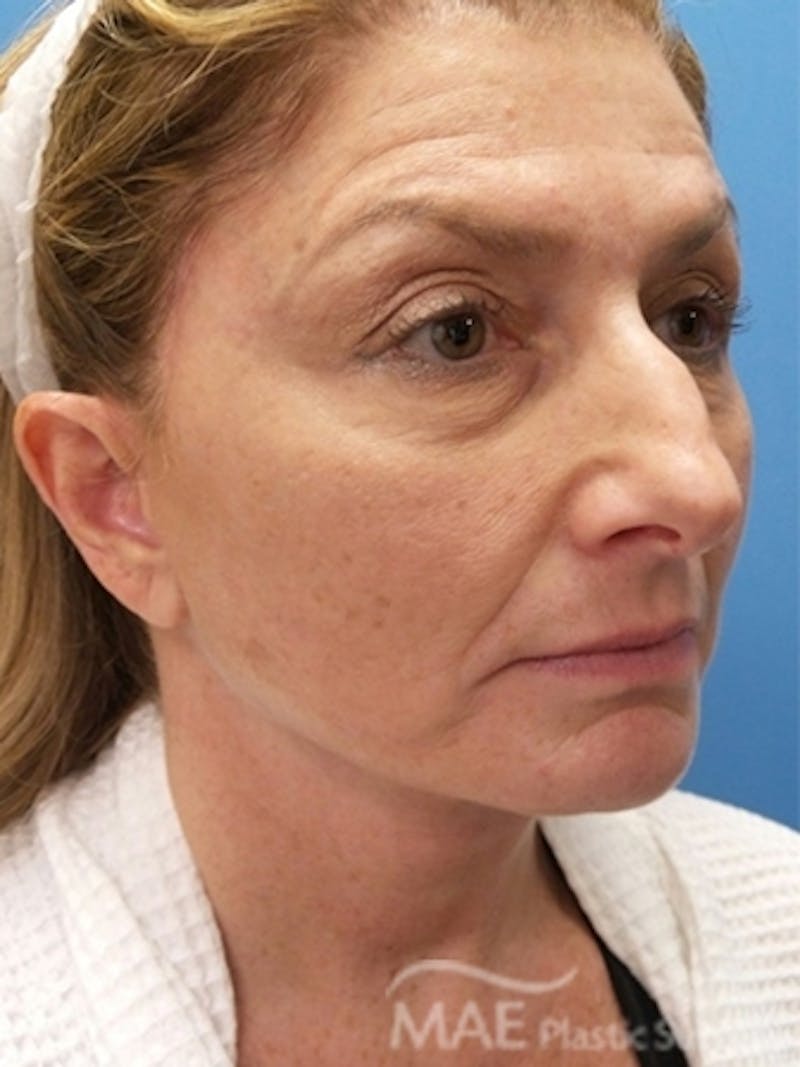 Facelift Before & After Gallery - Patient 313593 - Image 4