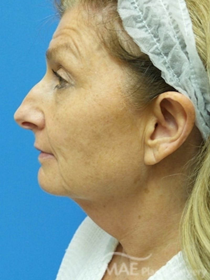 Facelift Before & After Gallery - Patient 313593 - Image 5
