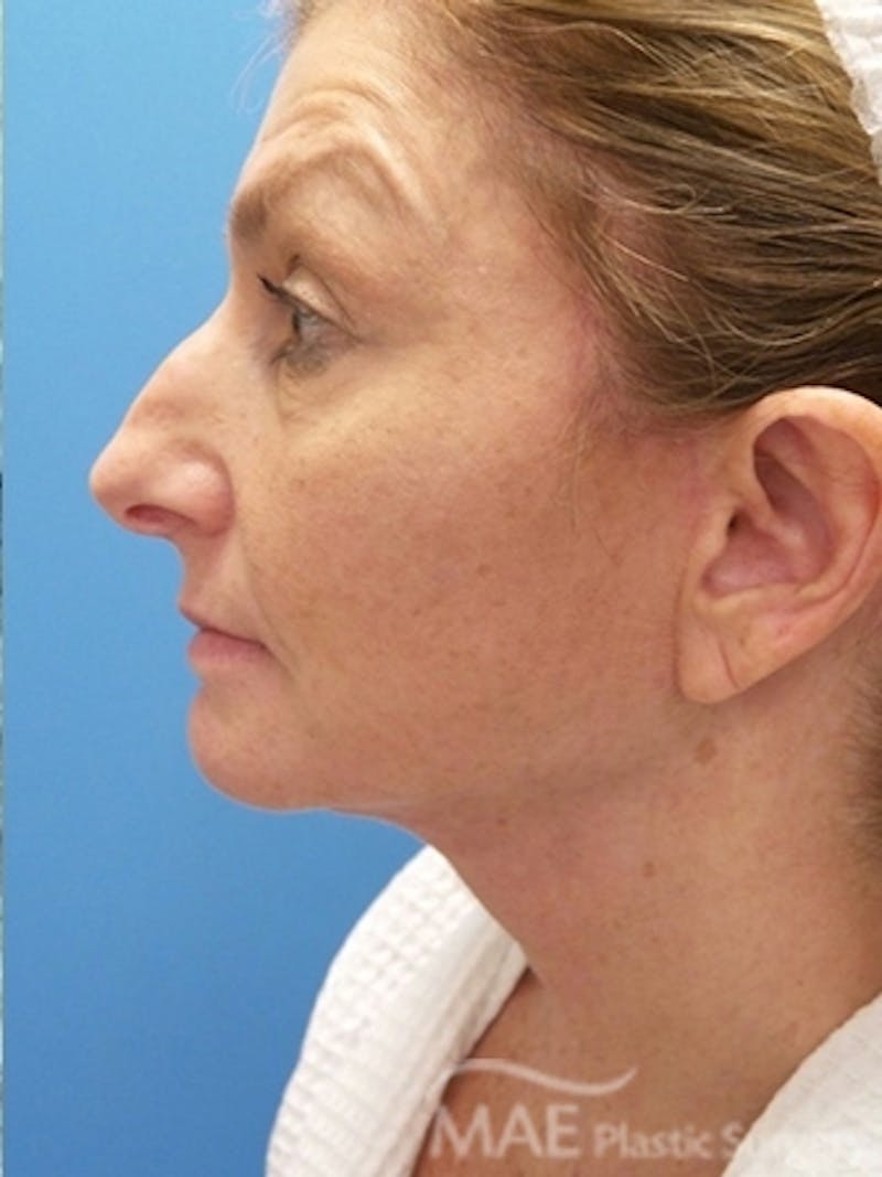 Facelift Before & After Gallery - Patient 313593 - Image 6
