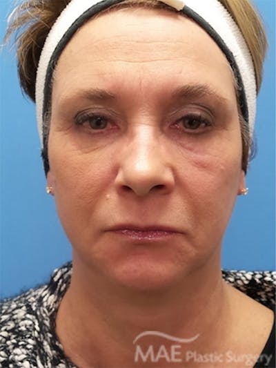 Facelift Before & After Gallery - Patient 261676 - Image 1