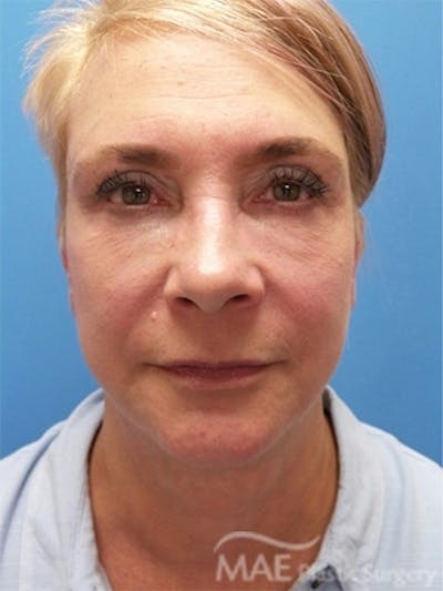 Facelift Before & After Gallery - Patient 261676 - Image 2