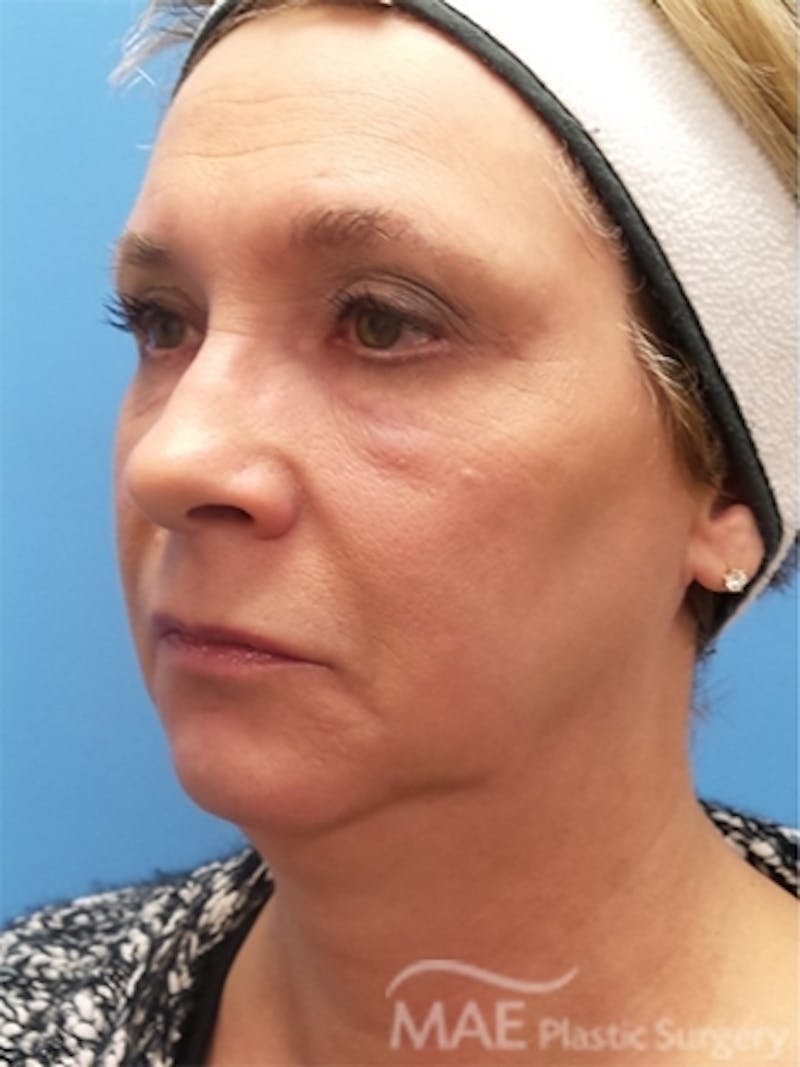 Facelift Before & After Gallery - Patient 261676 - Image 3