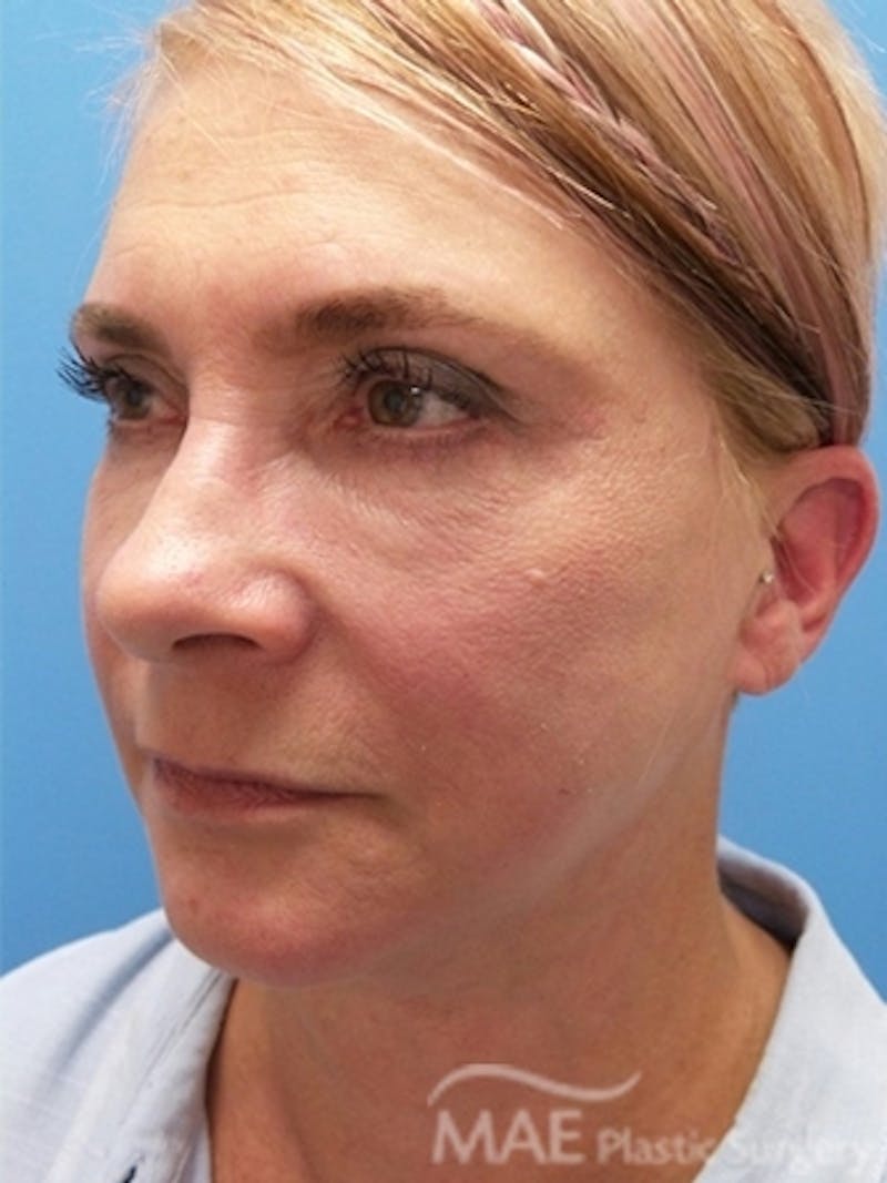 Facelift Before & After Gallery - Patient 261676 - Image 4