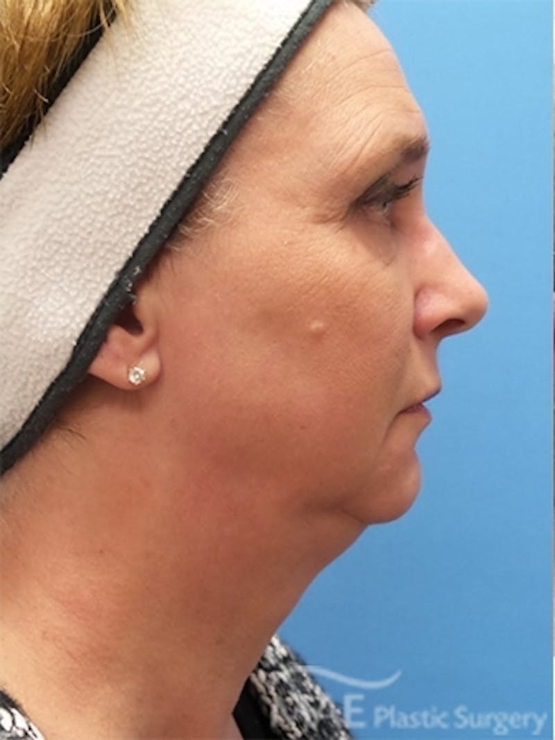 Facelift Before & After Gallery - Patient 261676 - Image 5