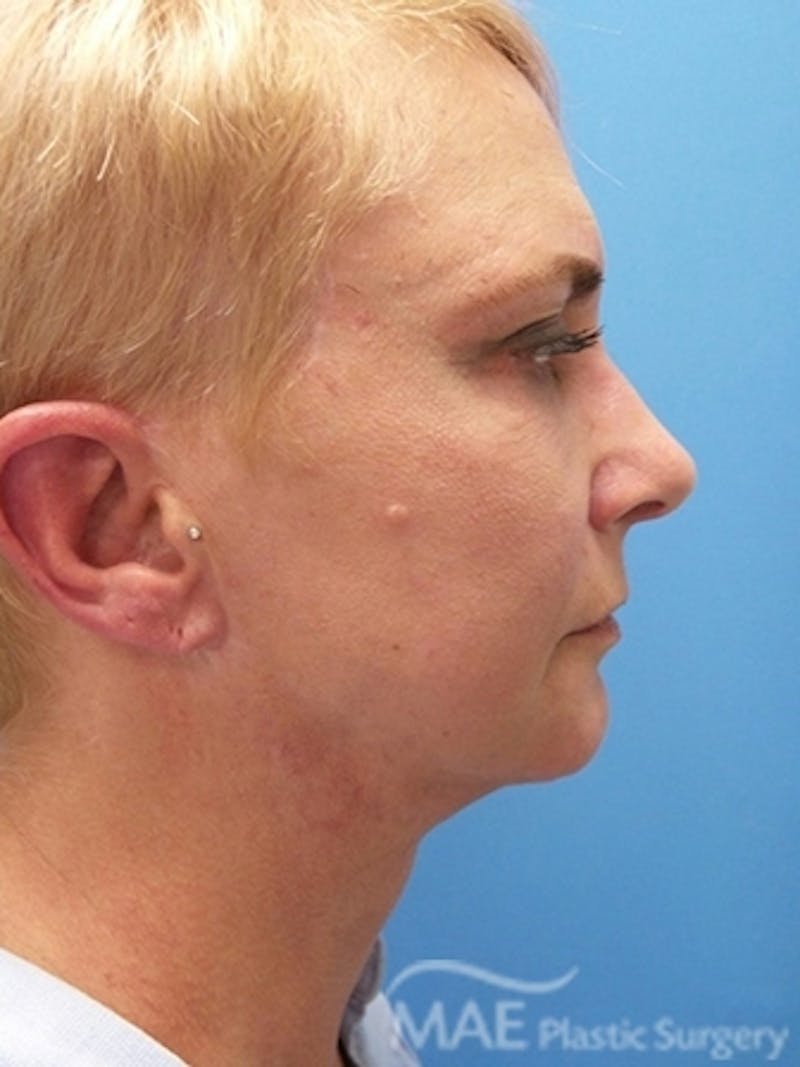 Facelift Before & After Gallery - Patient 261676 - Image 6
