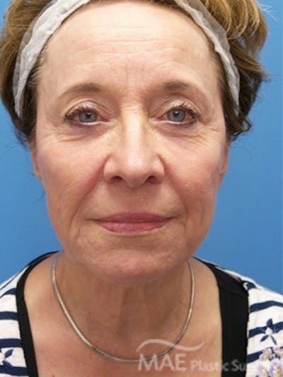 Facelift Before & After Gallery - Patient 108585 - Image 1