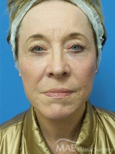 Facelift Before & After Gallery - Patient 108585 - Image 2