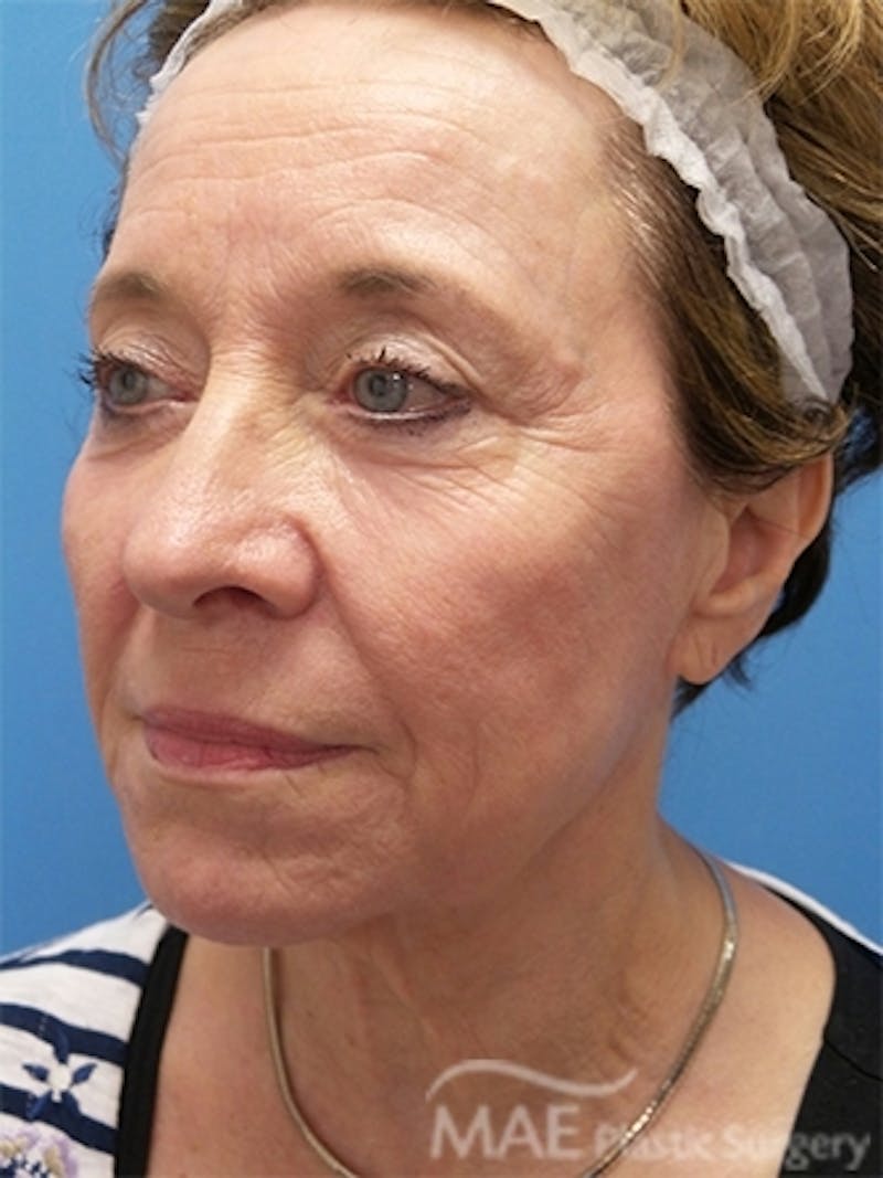 Facelift Before & After Gallery - Patient 108585 - Image 3