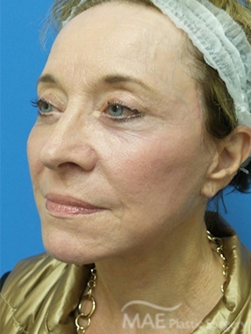 Facelift Before & After Gallery - Patient 108585 - Image 4