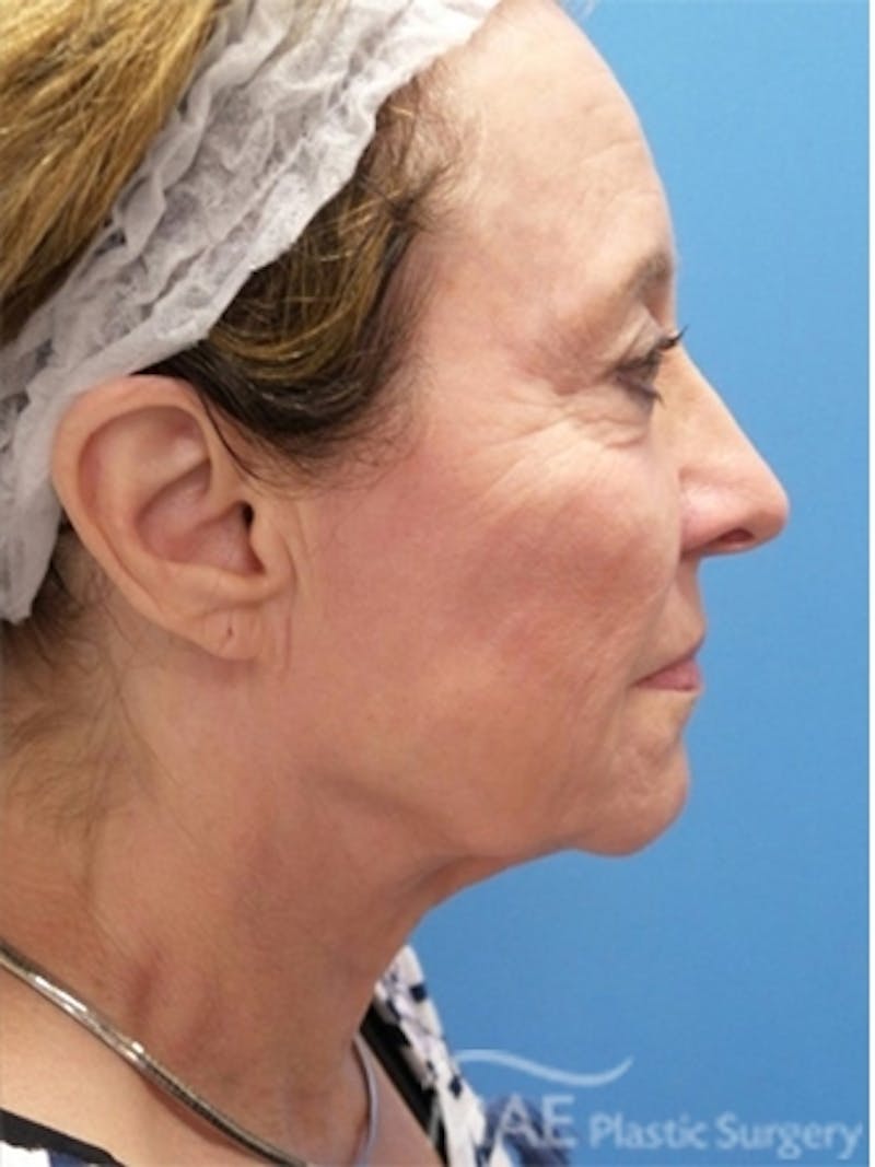 Facelift Before & After Gallery - Patient 108585 - Image 5