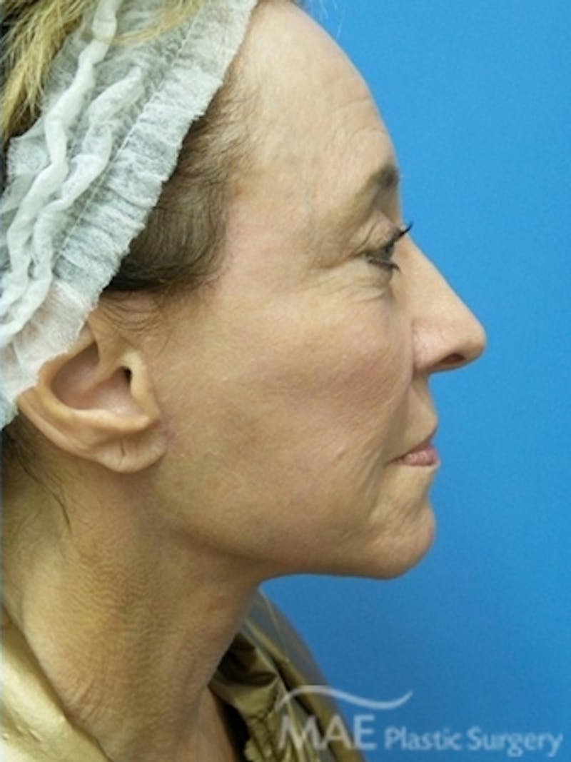 Facelift Before & After Gallery - Patient 108585 - Image 6