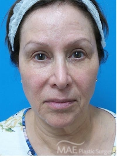 Facelift Before & After Gallery - Patient 587922 - Image 1