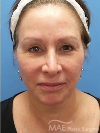 Facelift Before & After Gallery - Patient 587922 - Image 2