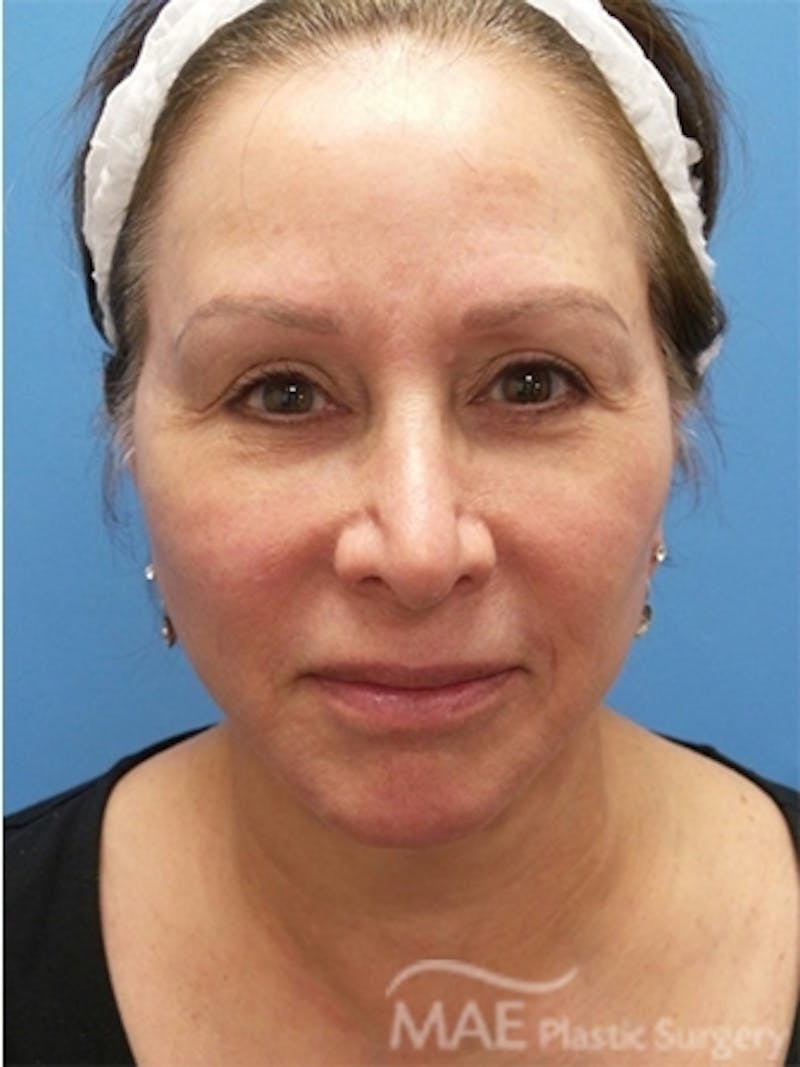 Facelift Before & After Gallery - Patient 587922 - Image 2