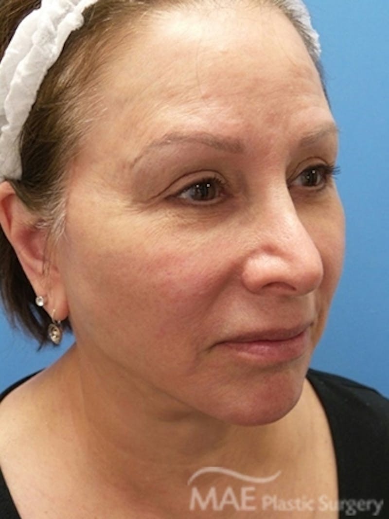 Facelift Before & After Gallery - Patient 587922 - Image 4