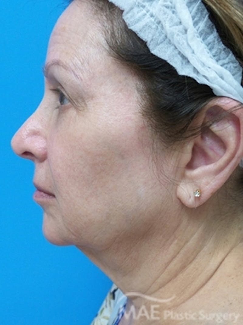 Facelift Before & After Gallery - Patient 587922 - Image 5