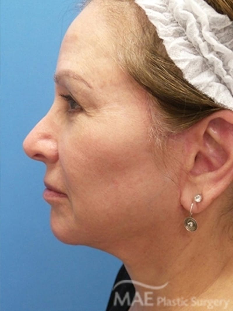 Facelift Before & After Gallery - Patient 587922 - Image 6