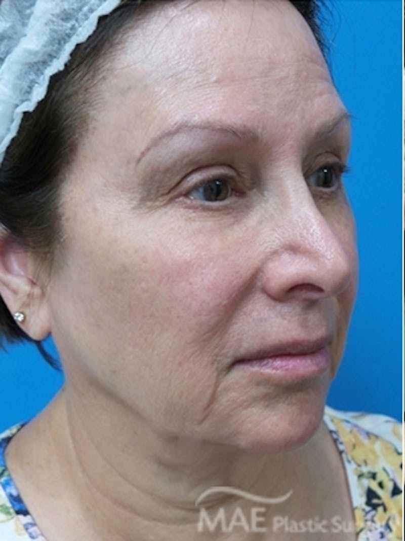 Facelift Before & After Gallery - Patient 587922 - Image 3