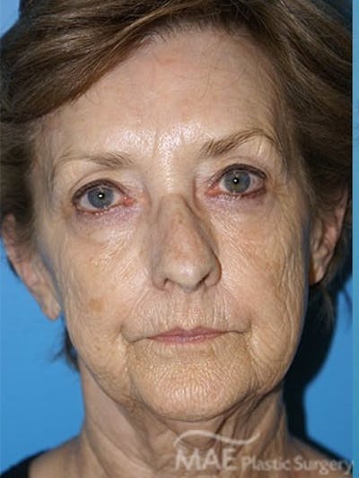 Facelift Before & After Gallery - Patient 233607 - Image 1