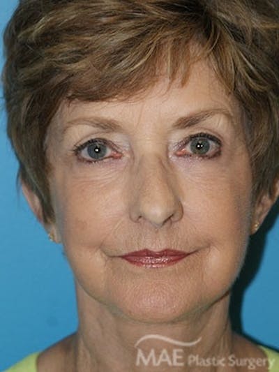 Facelift Before & After Gallery - Patient 233607 - Image 2