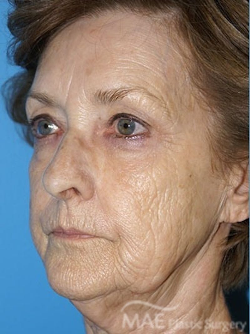 Facelift Before & After Gallery - Patient 233607 - Image 3