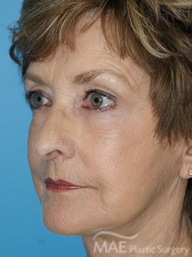Facelift Before & After Gallery - Patient 233607 - Image 4