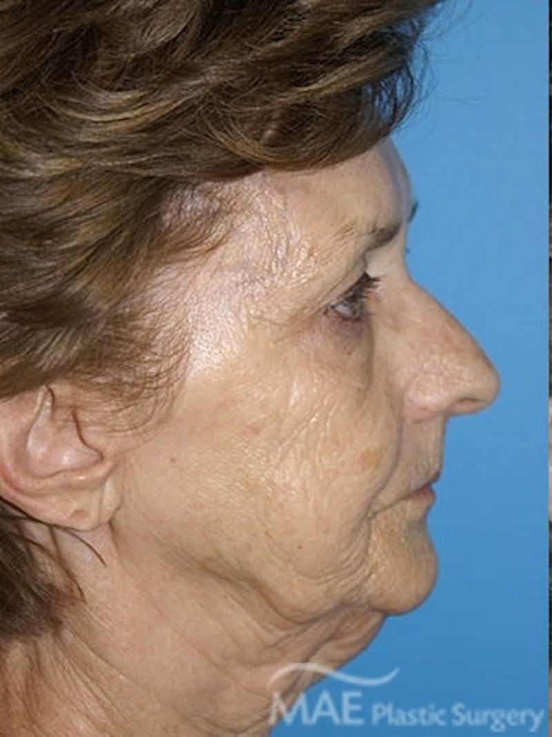 Facelift Before & After Gallery - Patient 233607 - Image 5
