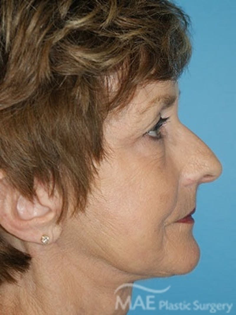 Facelift Before & After Gallery - Patient 233607 - Image 6
