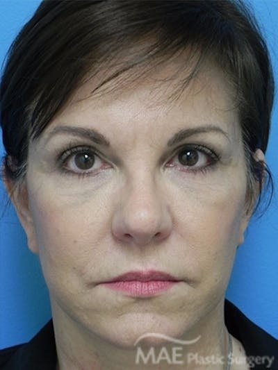 Facelift Before & After Gallery - Patient 276325 - Image 2
