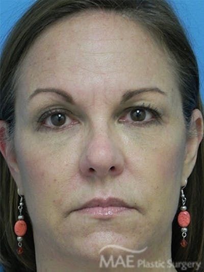 Facelift Before & After Gallery - Patient 276325 - Image 1