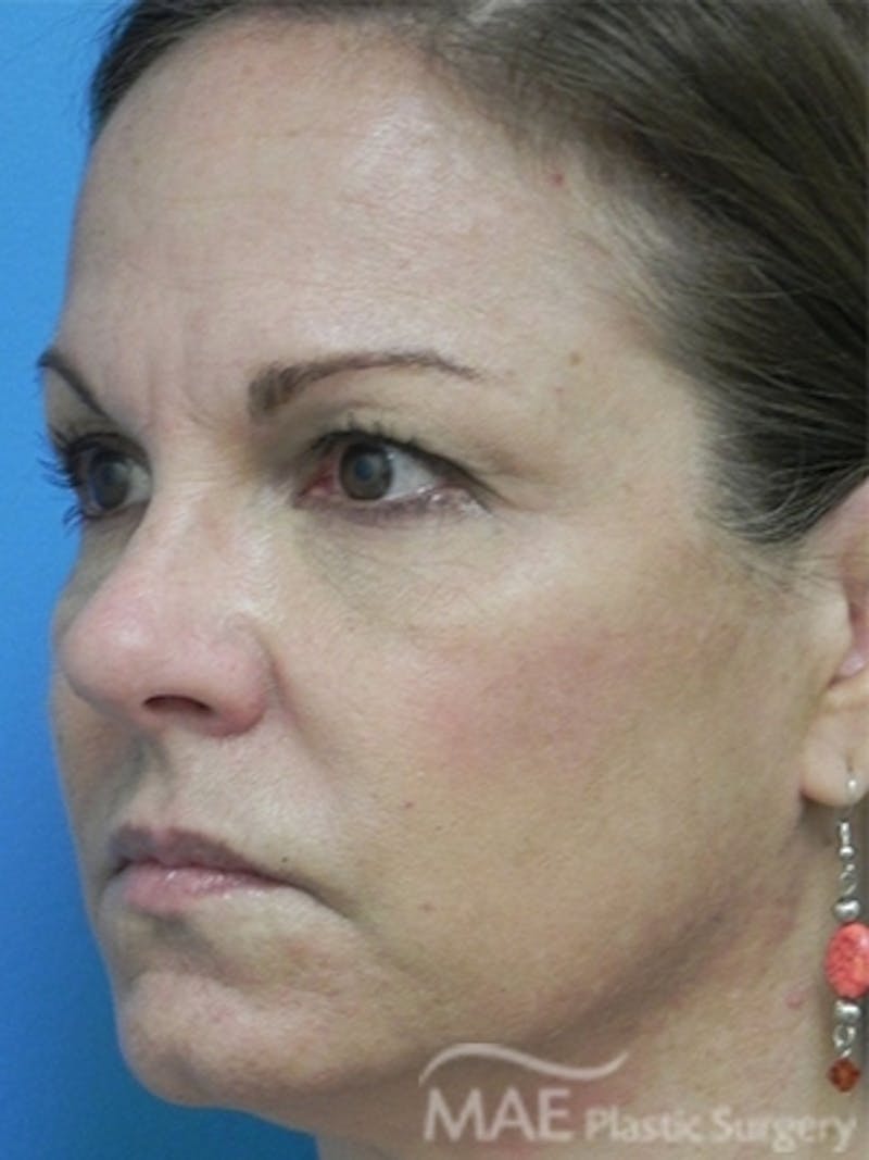 Facelift Before & After Gallery - Patient 276325 - Image 3