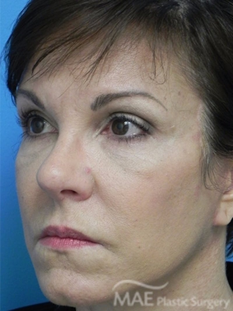 Facelift Before & After Gallery - Patient 276325 - Image 4