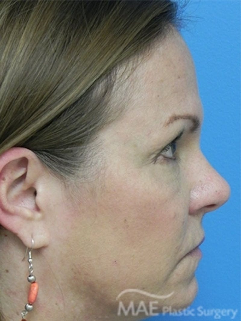 Facelift Before & After Gallery - Patient 276325 - Image 5