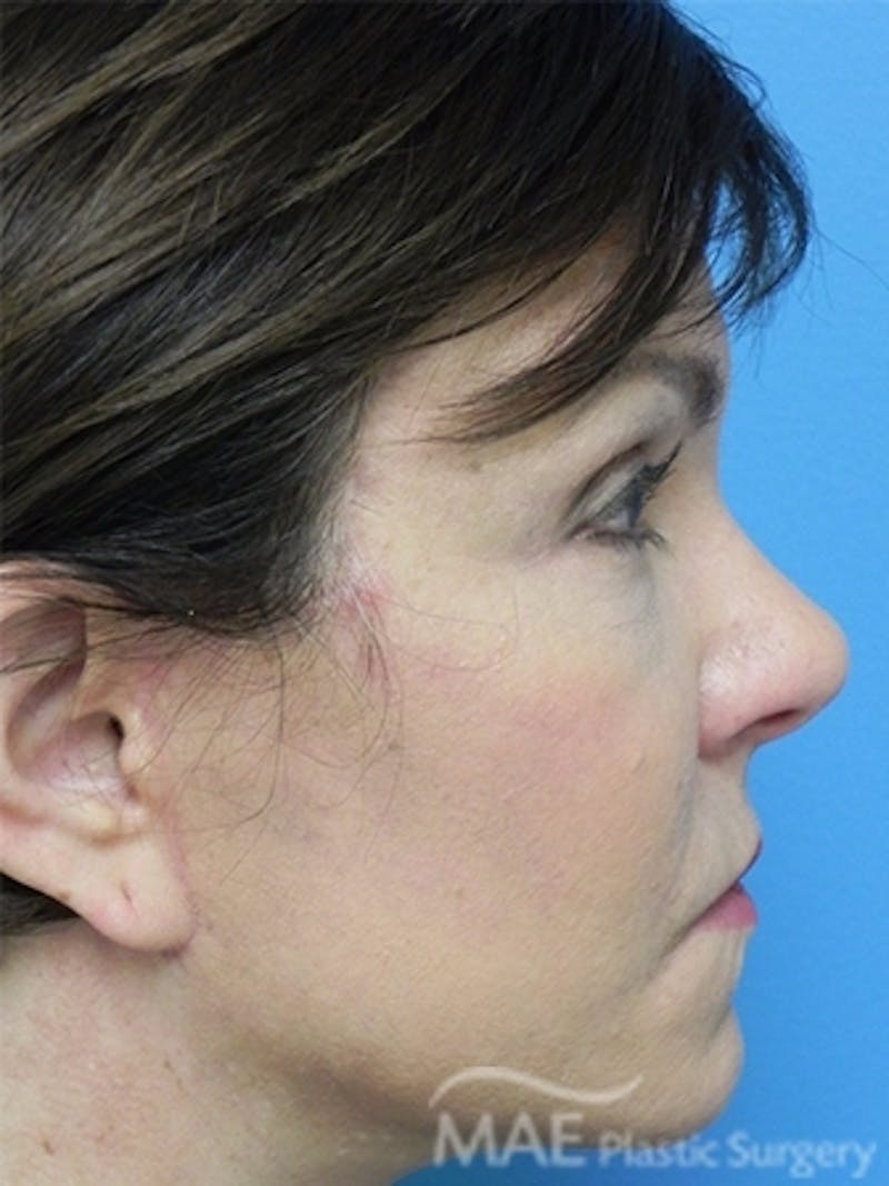 Facelift Before & After Gallery - Patient 276325 - Image 6