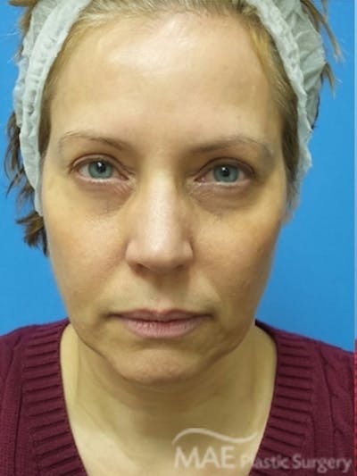 Facelift Before & After Gallery - Patient 581690 - Image 1