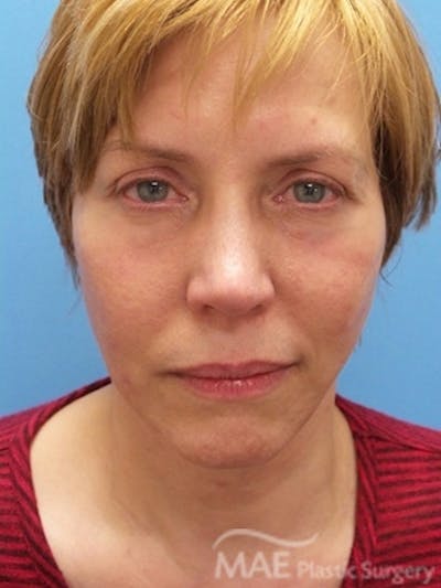 Facelift Before & After Gallery - Patient 581690 - Image 2