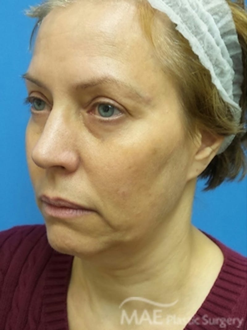 Facelift Before & After Gallery - Patient 581690 - Image 3