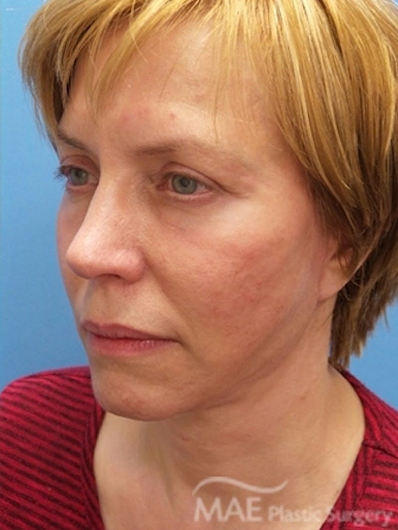 Facelift Before & After Gallery - Patient 581690 - Image 4