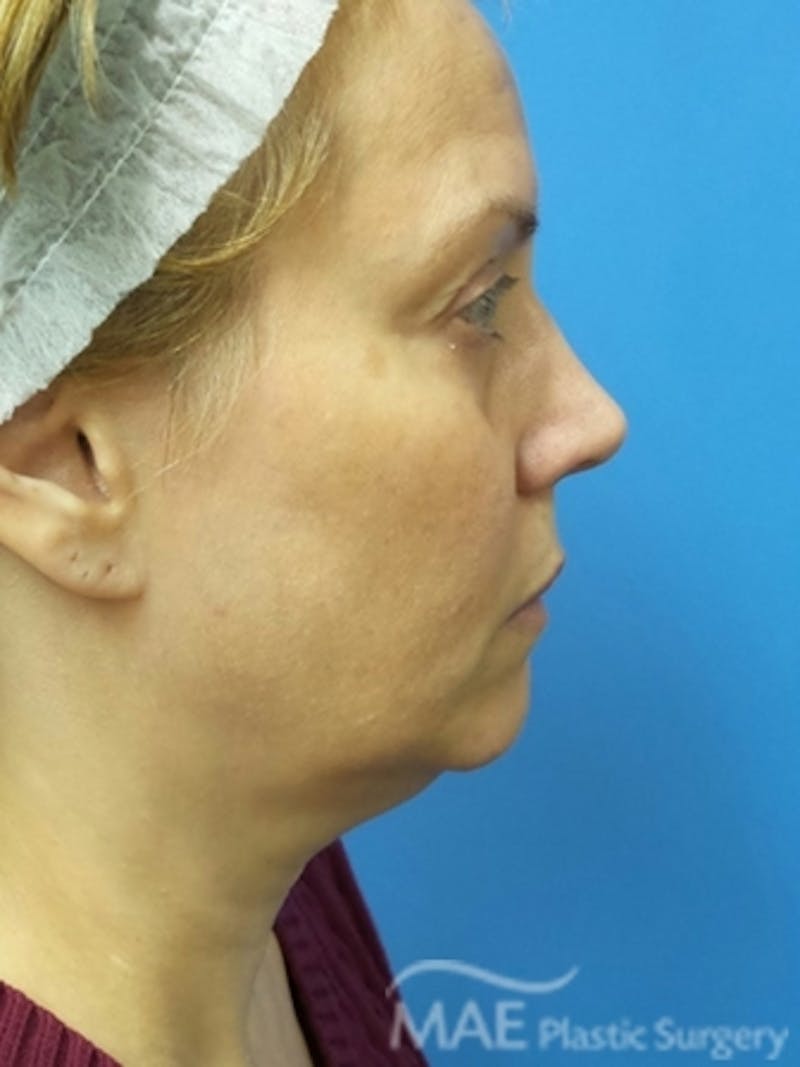 Facelift Before & After Gallery - Patient 581690 - Image 5