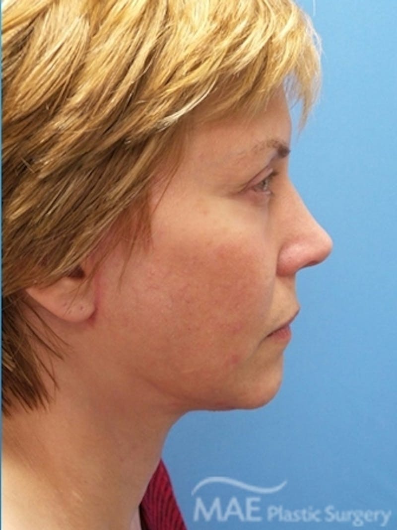 Facelift Before & After Gallery - Patient 581690 - Image 6