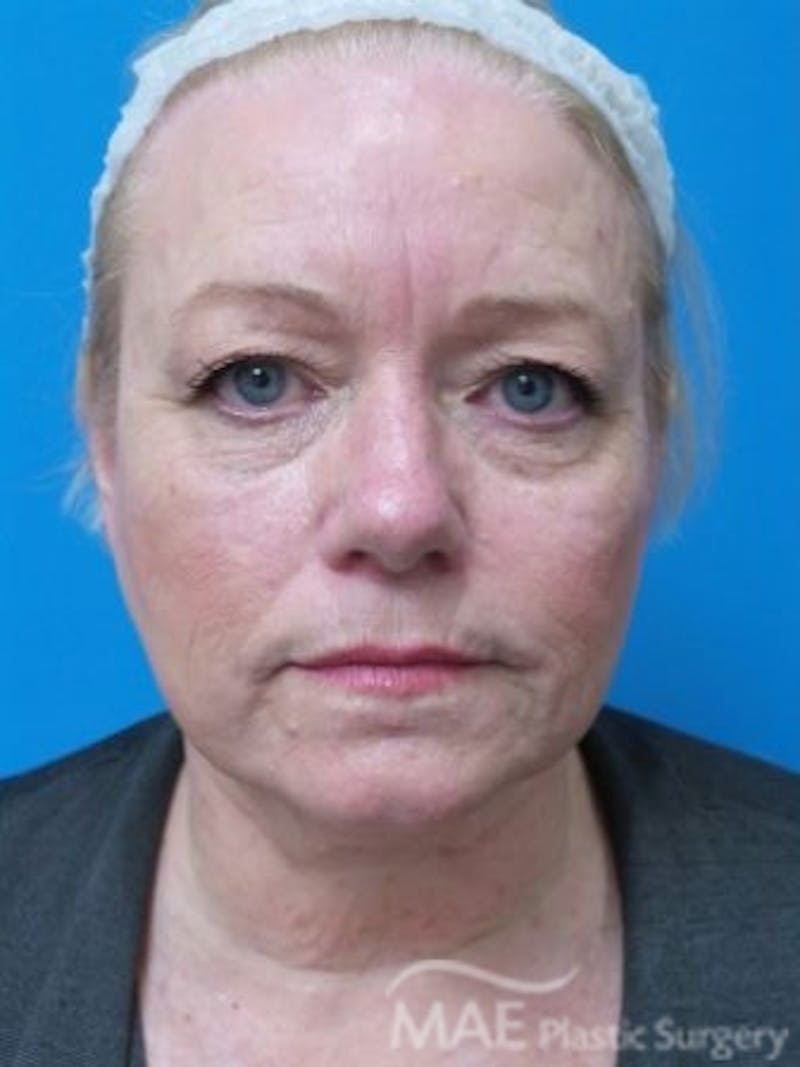 Facelift Before & After Gallery - Patient 170086 - Image 1