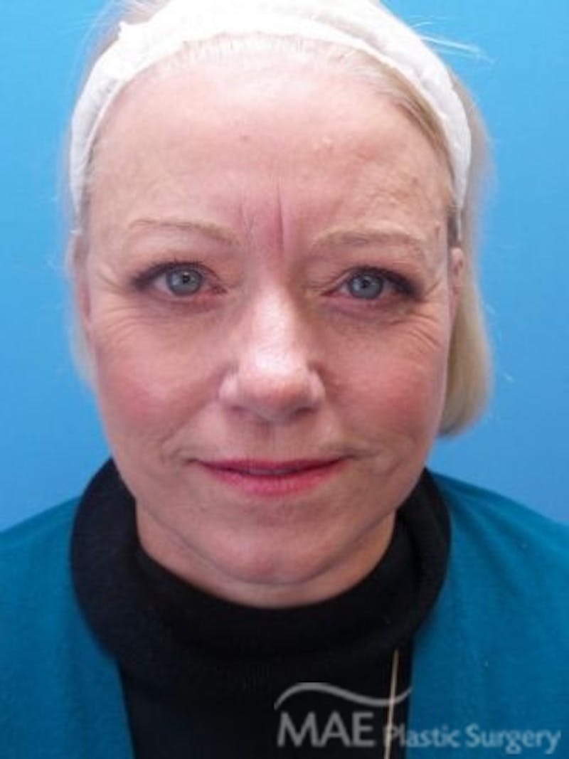 Facelift Before & After Gallery - Patient 170086 - Image 2