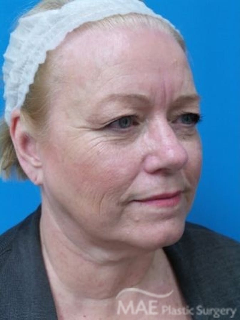 Facelift Before & After Gallery - Patient 170086 - Image 3