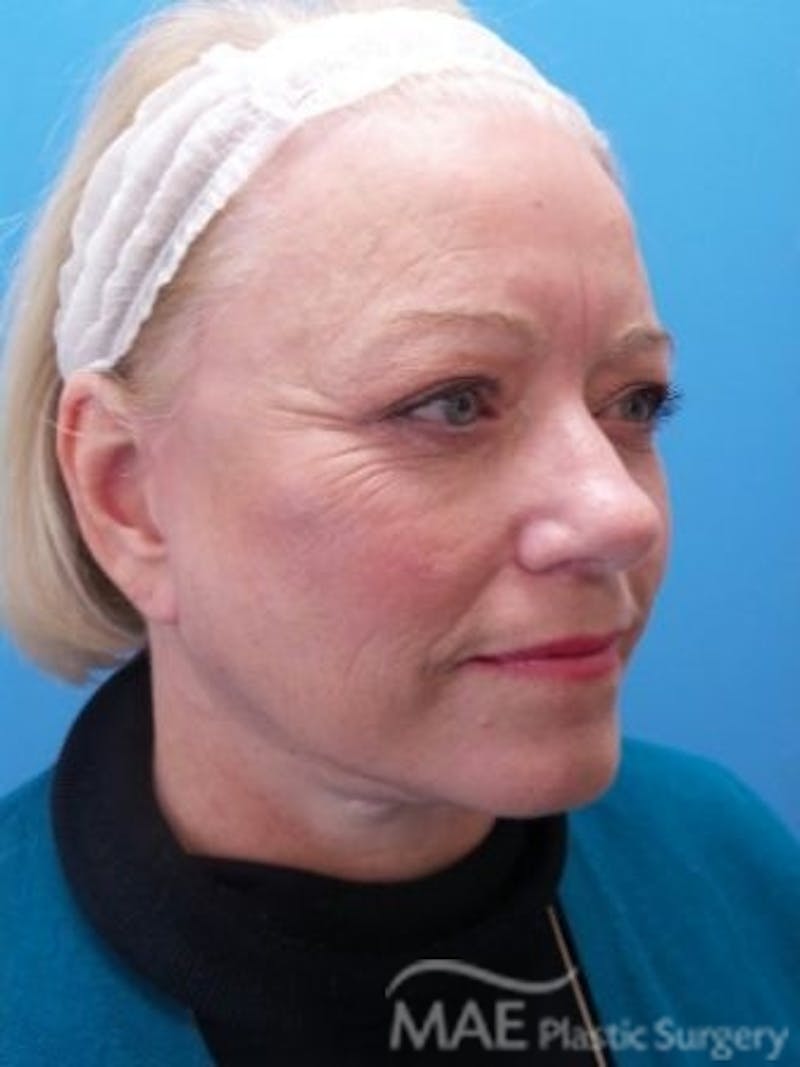 Facelift Before & After Gallery - Patient 170086 - Image 4
